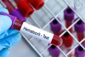hematocrit testing Houston TX blood sample analysis